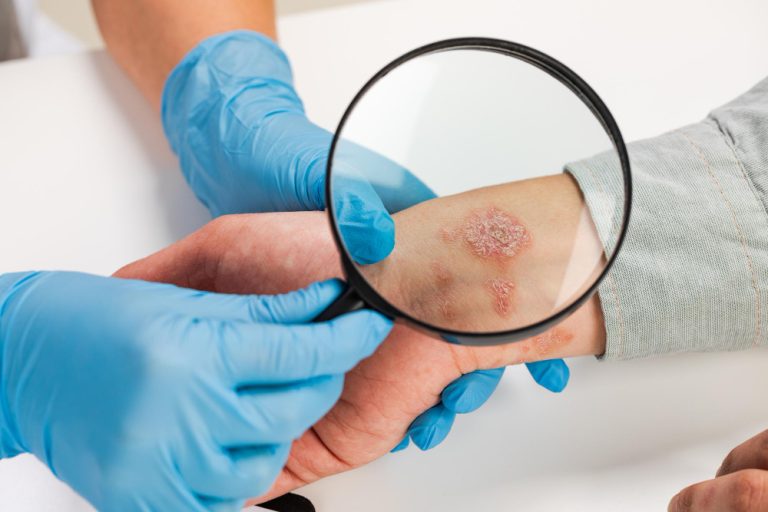Dermatita